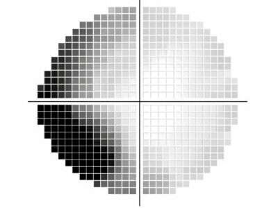 視野検査のグレースケール・TD・PDとは？意味と違いをわかりやすく解説