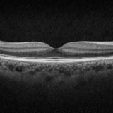 CIRRUS OCTのGanglion Cell解析を徹底解説|GCL+IPLの意味とレポートの見方