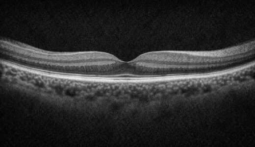 ETDRSグリッドって何？──眼科OCTレポートでよく見るアレの正体