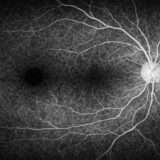 CIRRUS OCTのPanoMap解析とは?構成・見方・特徴を徹底解説