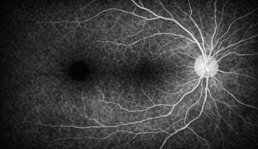 CIRRUS OCTのPanoMap解析とは？構成・見方・特徴を徹底解説