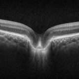 RNFLサークルの断層像ってなに？“ぐるっと一周”の不思議な画像を読み解く