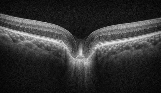 RNFLサークルの断層像ってなに？“ぐるっと一周”の不思議な画像を読み解く