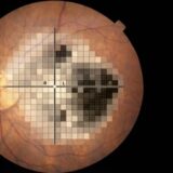 眼科検査画像を重ねて比較･確認するための無料ツール集｜緑内障フォロー･血管造影確認などに