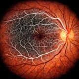 眼科向け｜画像の黒→透明に　OCT-A造影の背景を透明にするツール（β版）