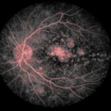 眼科向け｜画像の白に色付け　FA•ICGの血管造影画像に色を付けるツール（β版）